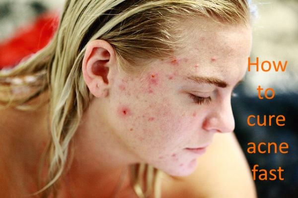 How to cure acne fast